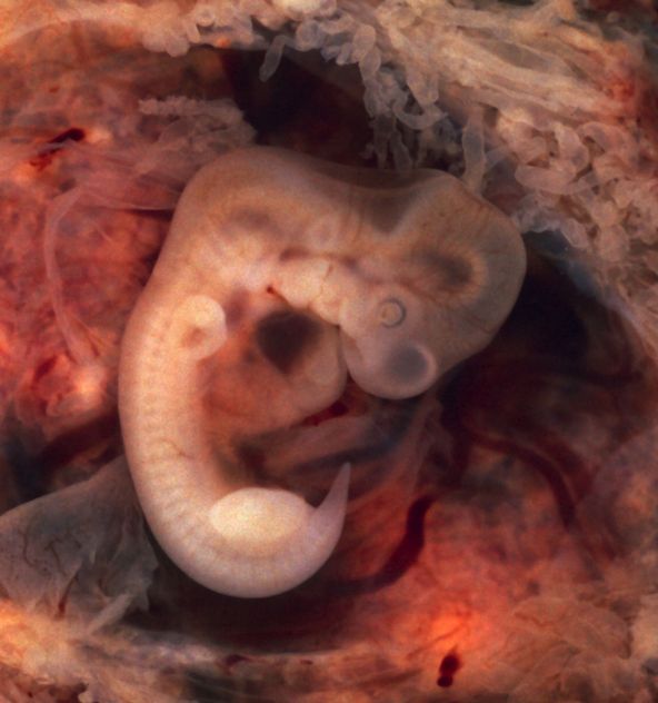 Tubal_Pregnancy_with_embryo